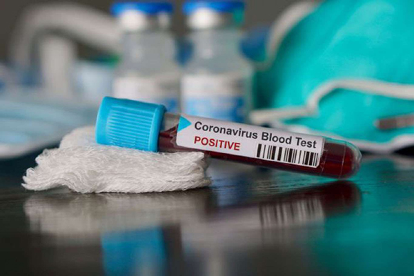 Koronavirüsü salgını: 123 kişi daha öldü, 19 bin 126 yeni vaka tespit edildi