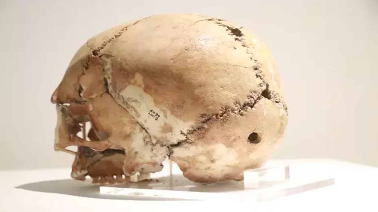 İlk beyin ameliyatına ait kafatası